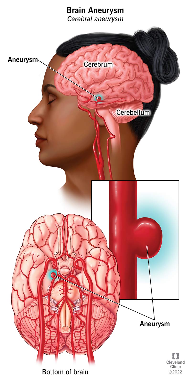 Intracranial aneurysm illustration